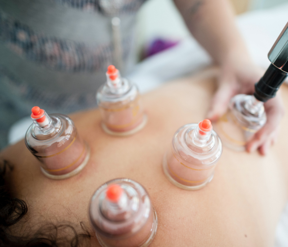 cups being placed on woman's back